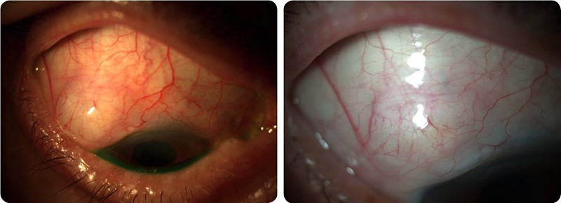 Fig.1 Needling com 5-FU – Aspeto antes (A) e depois (B) do needling (bolha difusa e menos vascularizada).