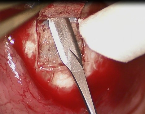 Figura 4 - Flap escleral (disseção na região central próximo do limbo)
